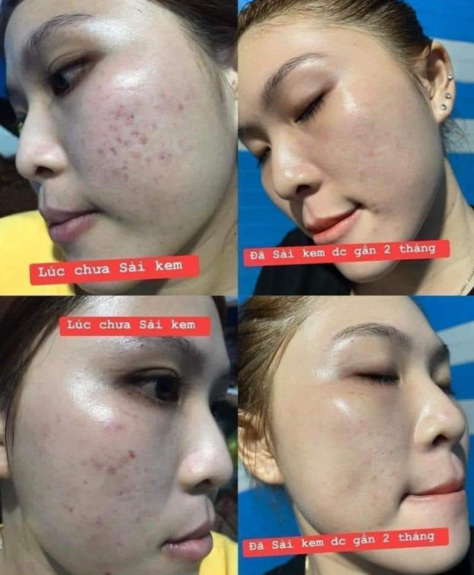 giảm mụn hiệu quả