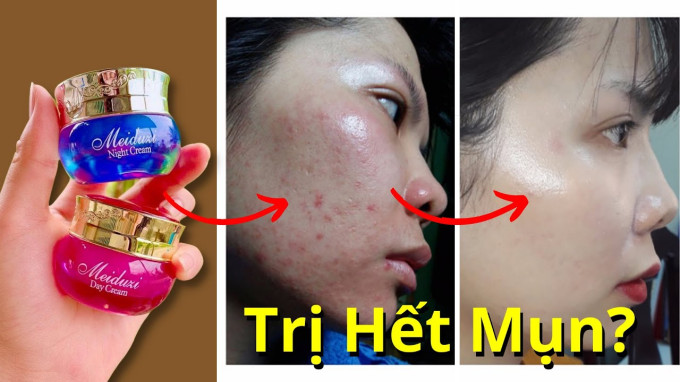 Trị mụn hiệu quả