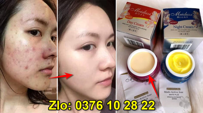 Thâm nám cũng hết