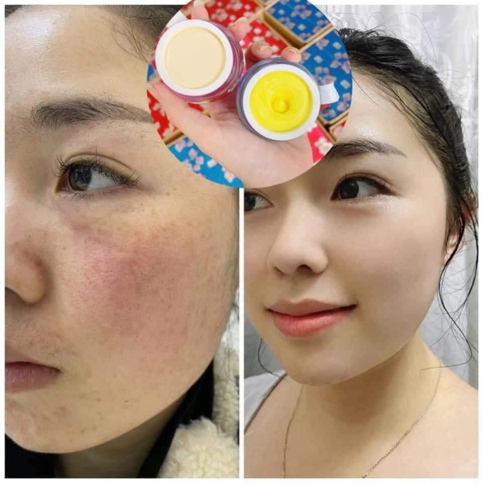 Vết nám cũng được đánh bay