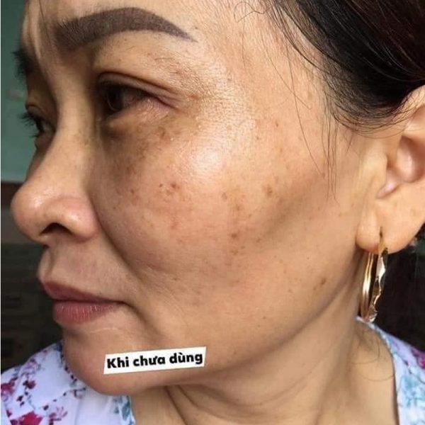 trước khi sử dụng kem nám huyền phi