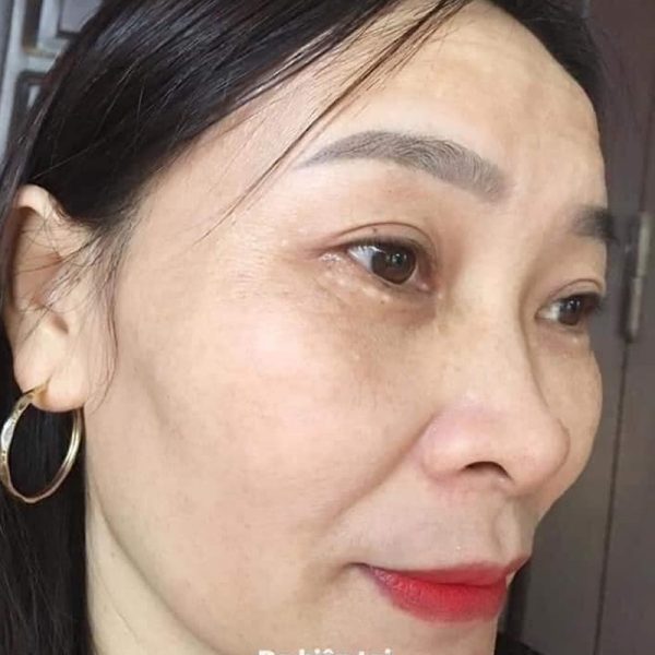 sau khi sử dụng kem nám huyền phi