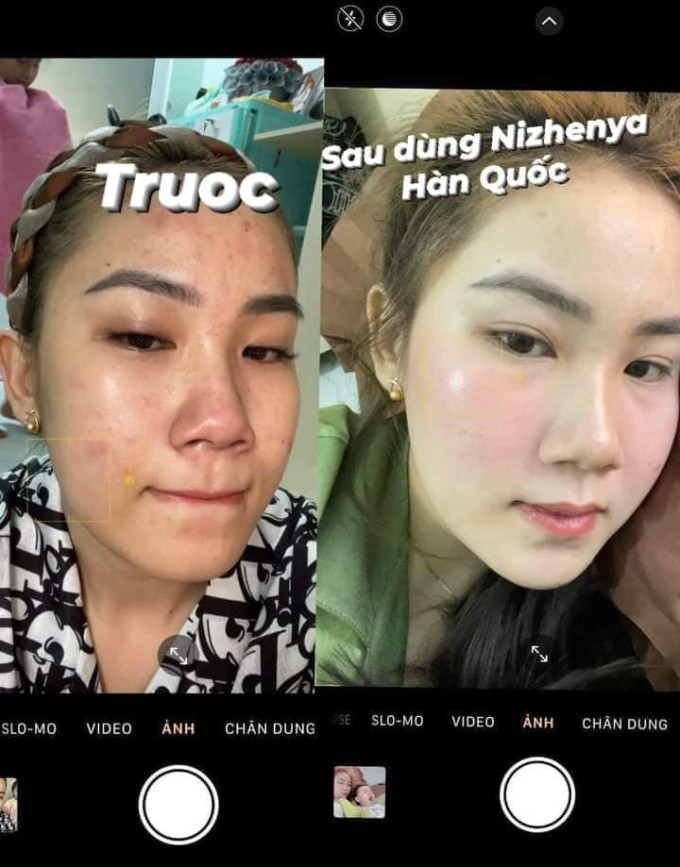 Kem Nizhenya trị mụn hiệu quả