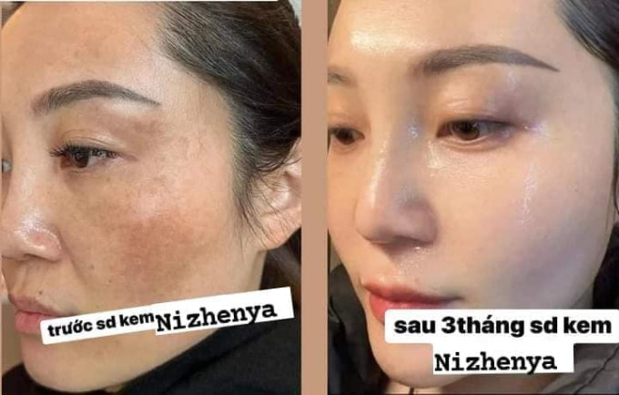 Kem Nizhenya hỗ trợ trị nám hiệu quả