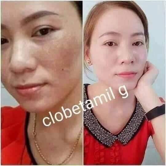 Kem Trị Nám Clobetamil G Thái Lan có thực sự tốt không? Có an toàn không?