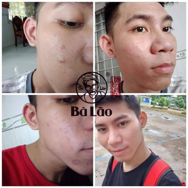 Sản phẩm trị mụn bà lão sài cho cả nam