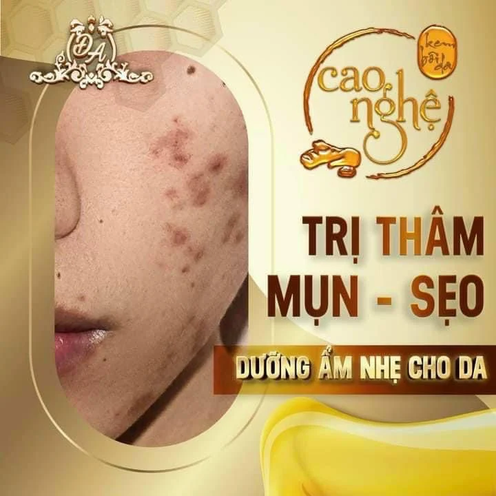 Trị thâm- mụn sẹo hiệu quả