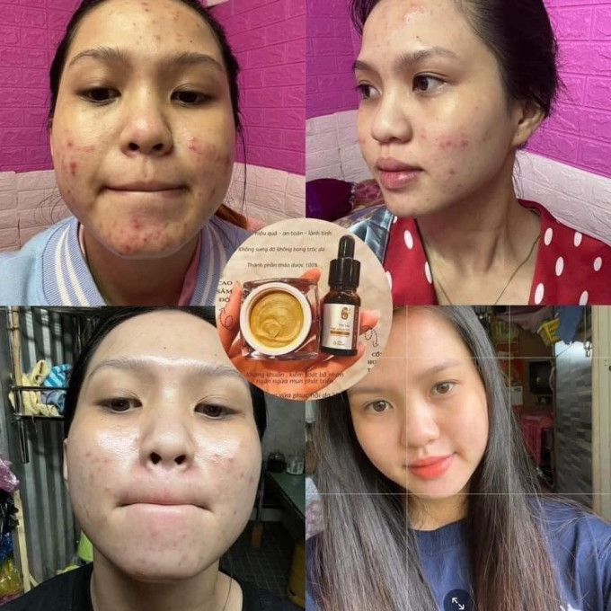 Cao mụn sâm đỏ nhận được nhiều phản hồi tích cực của khách hàng