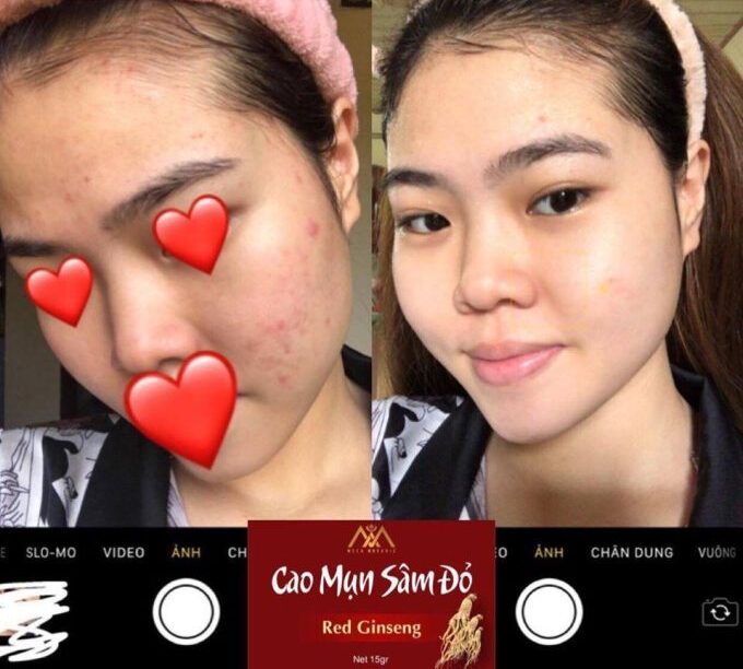 Điều trị các loại mụn